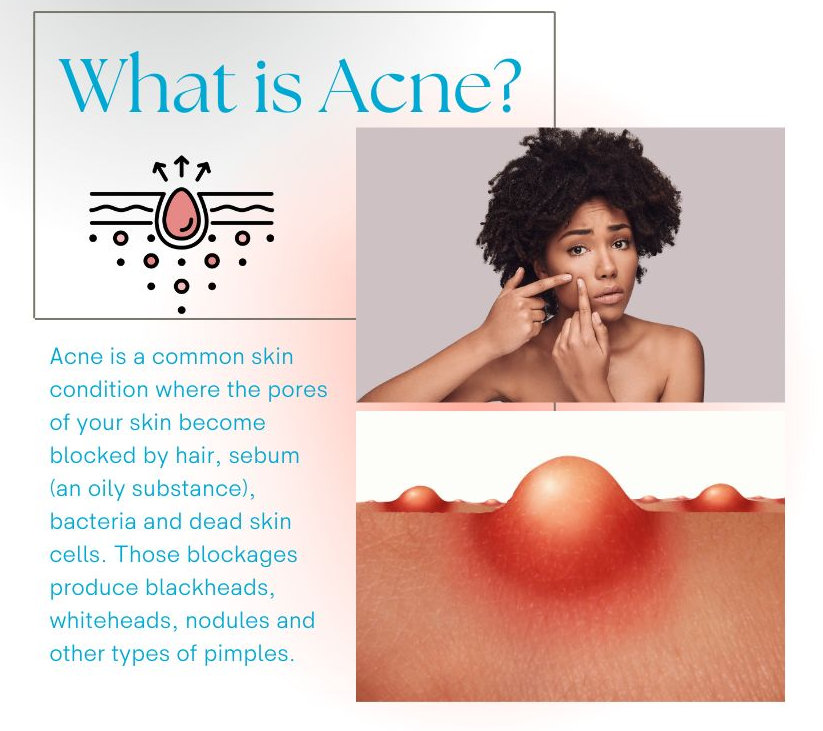 What is acne