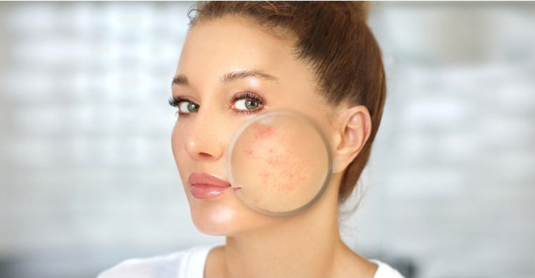 acne2
